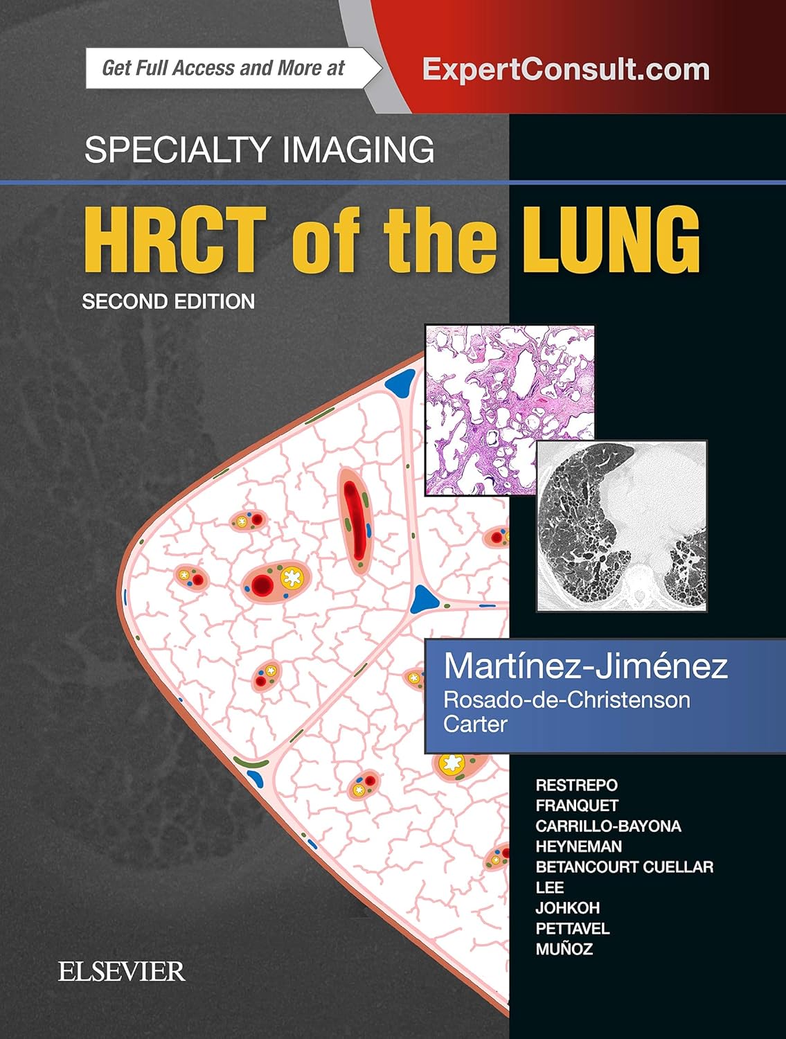 Specialty Imaging: HRCT of the Lung: Anatomic Basis, Imaging Features, Differential Diagnosis. ExpertConsult.com Specialty Imaging: HRCT of the Lung: Anatomic Basis, Imaging Features, Differential Diagnosis. ExpertConsult.com