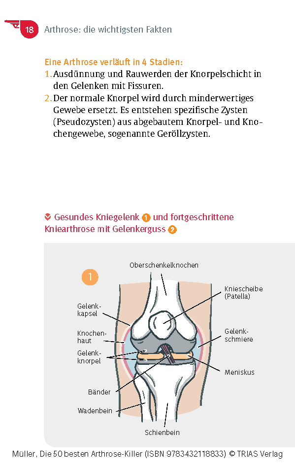 Die 50 besten Arthrose-Killer Die 50 besten Arthrose-Killer