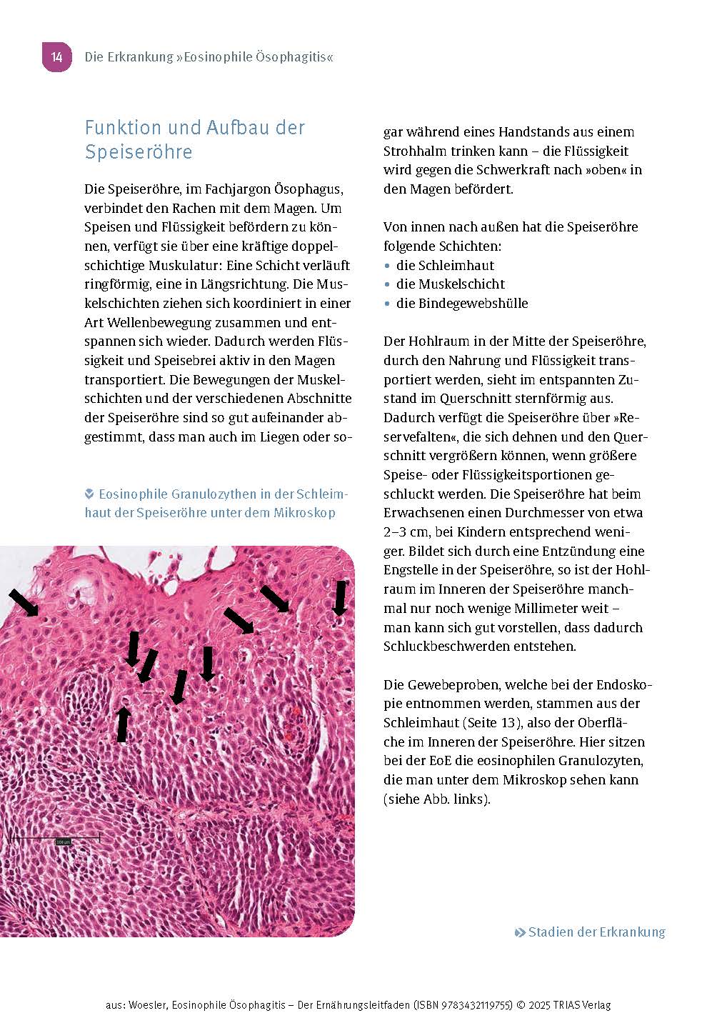 Eosinophile Ösophagitis - Der Ernährungsleitfaden