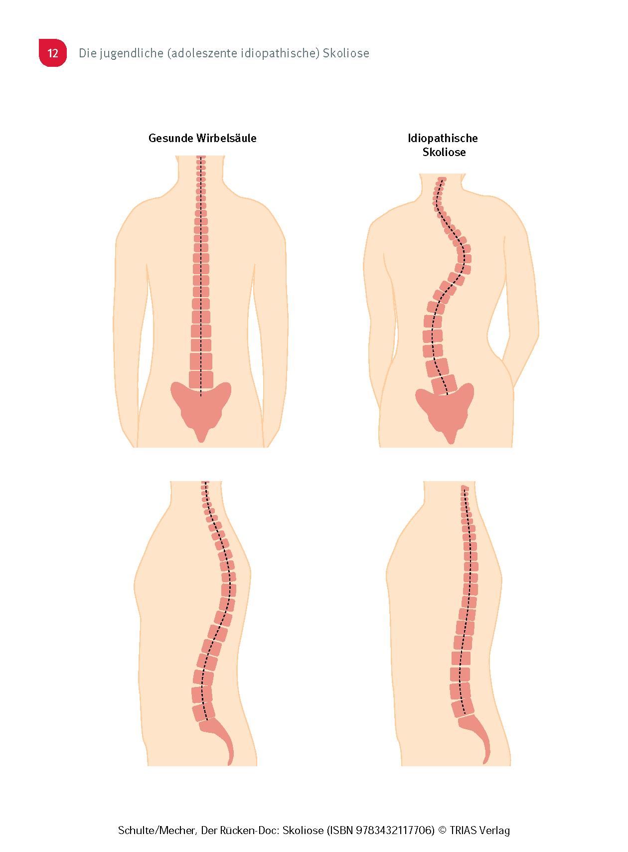 Der Rücken-Doc: Skoliose