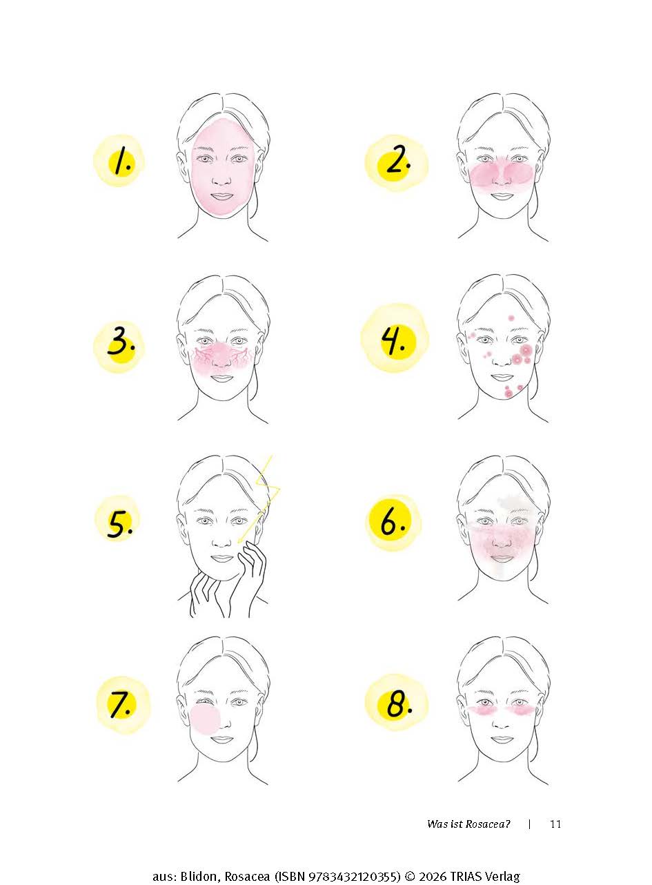 Rosacea