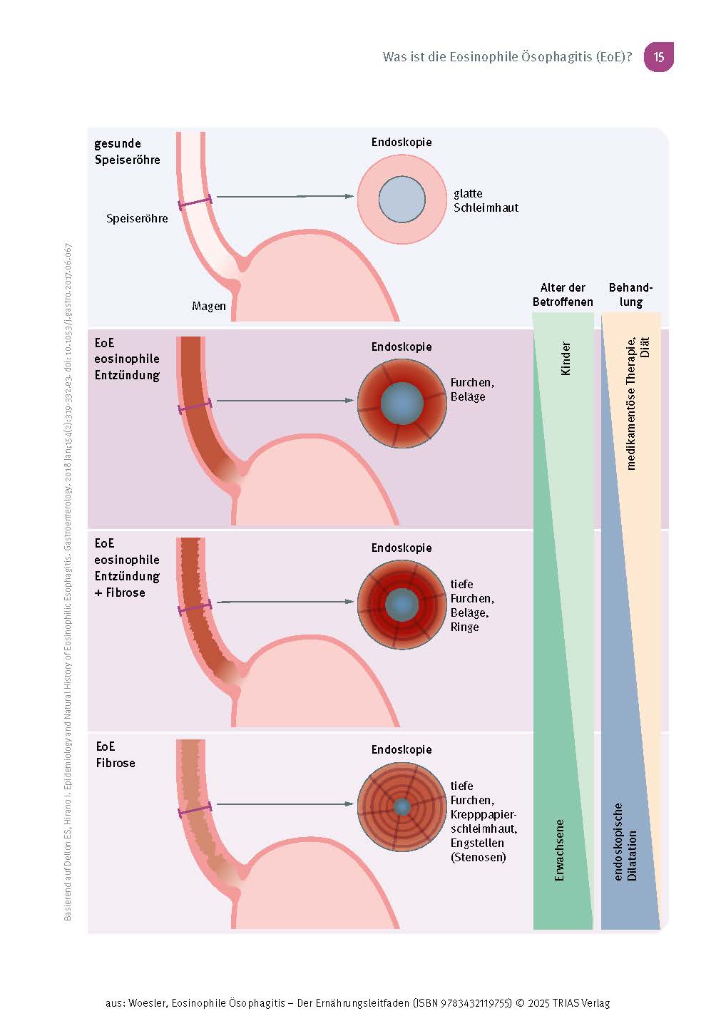Eosinophile Ösophagitis - Der Ernährungsleitfaden