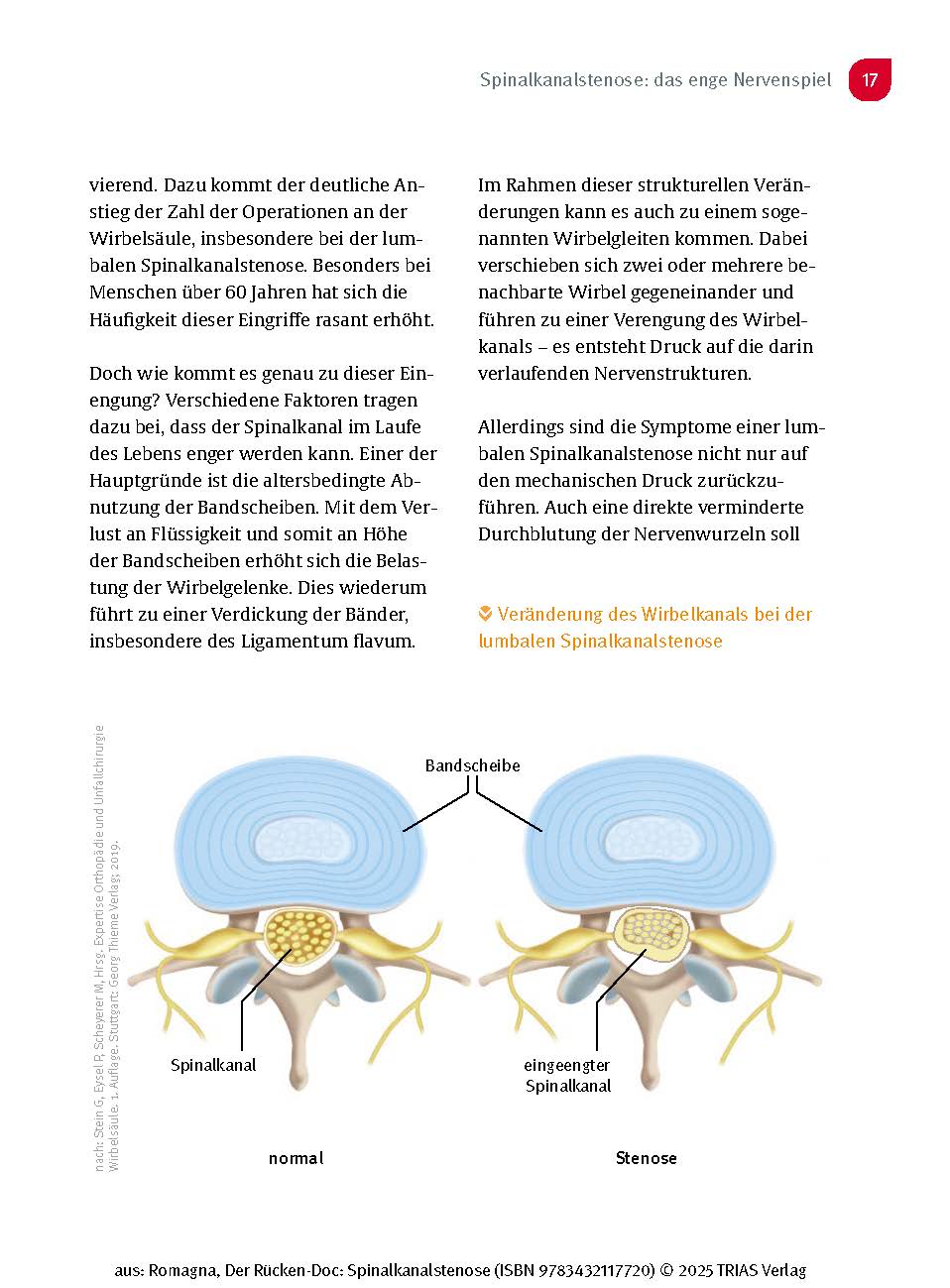 Der Rücken-Doc: Spinalkanalstenose
