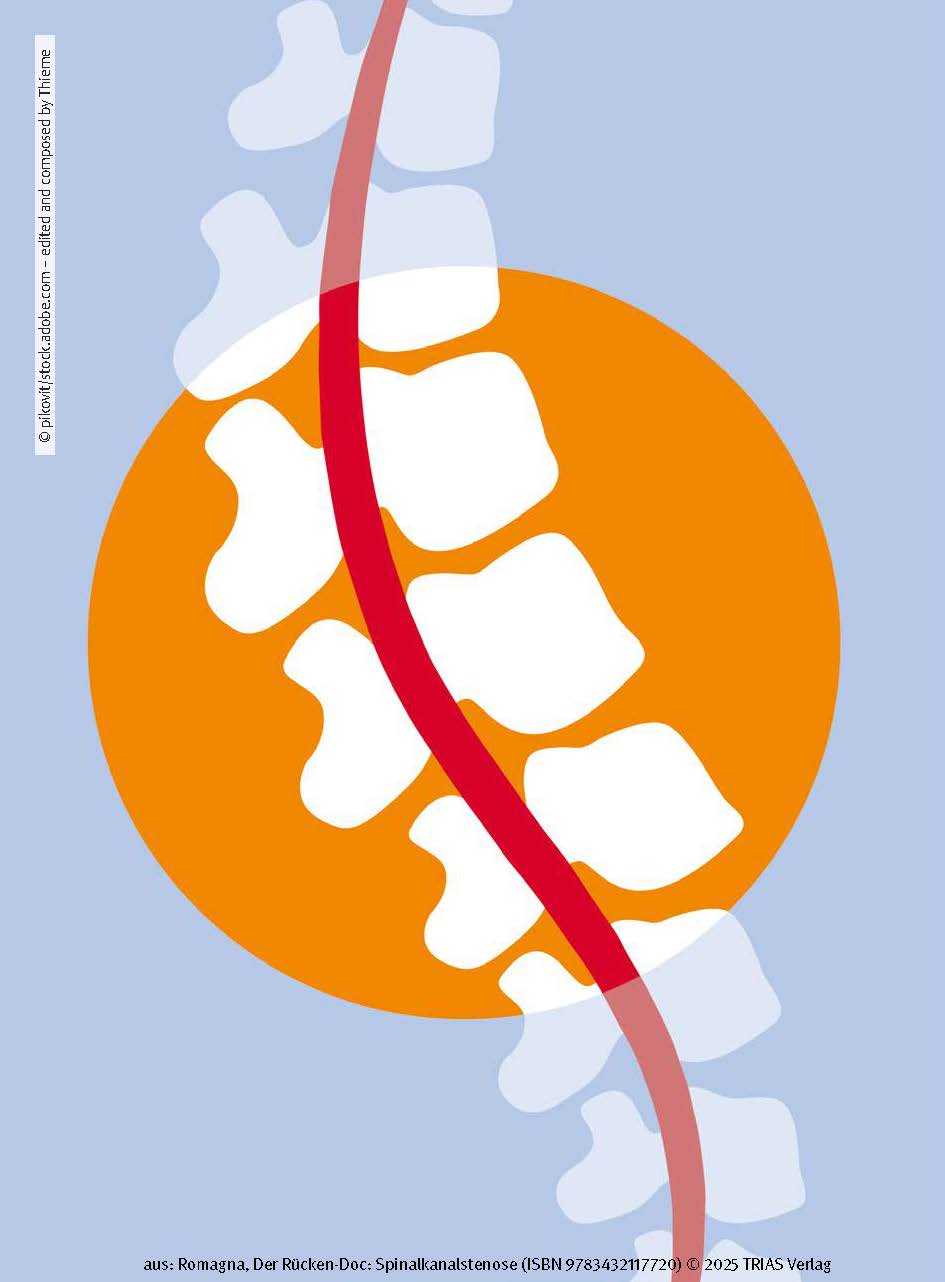 Der Rücken-Doc: Spinalkanalstenose
