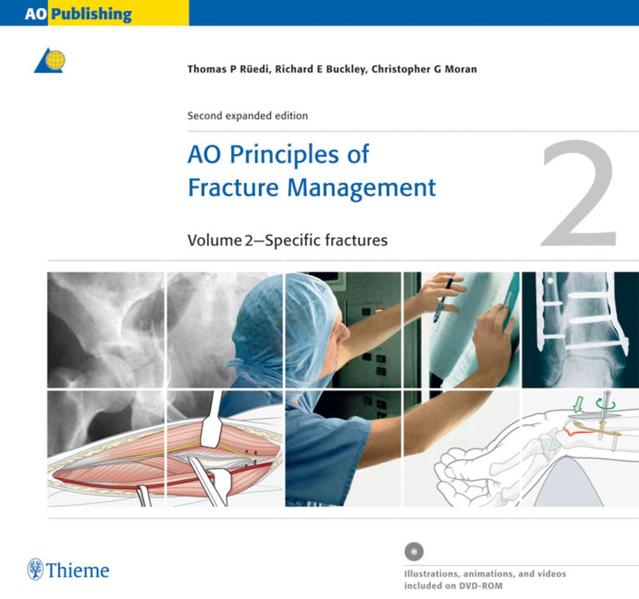 AO Principles of Fracture Management