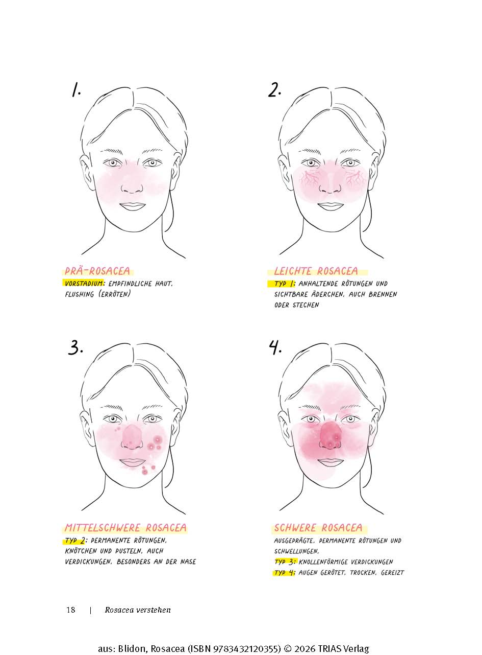 Rosacea